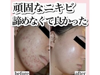 ホワイトアクア 池袋店(WHITE AQUA)/ハーブピーリング/毛穴洗浄/池袋