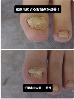 肥厚爪改善と変形予防を行う方法