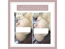 アヤエステティックサロン 綱島店(AYA)/モニター様