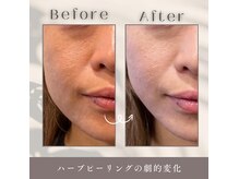 ソア(Soa)の雰囲気（剥離なし/ダウンタイムなし韓国式ハーブピーリングの変化が凄い）