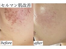 ロイヤル ビューティー サロン(Royal Beauty Saloon)/韓国発最新肌管理【セルマン】