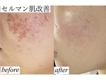 ロイヤル ビューティー サロン(Royal Beauty Saloon)/韓国発最新肌管理【セルマン】