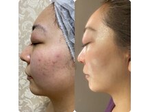 リアンボーテ(Lien Beaute)の雰囲気（【お客様の事例】ハーブピーリングの効果でツヤ肌になりました。）