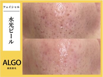 アルゴ 小倉守恒店(ALGO)/水光ピール