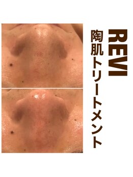 心斎橋 ルヴィ(REVI)/ハーブピーリングの変化