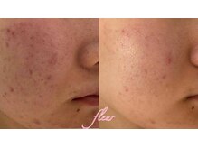 フルール(Fleur)/◆肌質改善◆