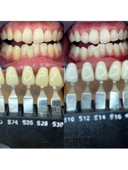 トウキョウスワーズ 池袋店(TOKYO SWRS)/#ホワイトニング #池袋 #渋谷