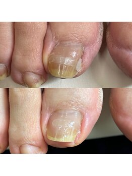 巻き爪矯正2回目(右親指)