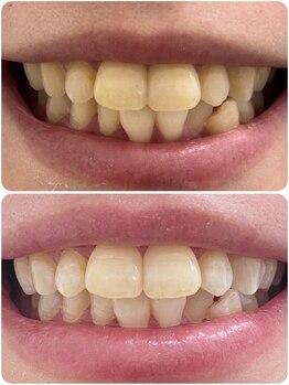 ホワイトニングショップ 泉佐野店/ご新規様初回before after