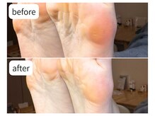 カシェット(Cachette)/40代女性◎足裏角質ケア90分