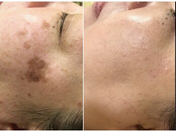 コスメ デ グレース(cosme de greace)/大きいシミがなくなっています！