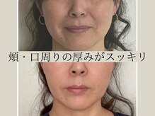 オルビナ(Orbina)/小顔矯正