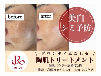 ホワイトアクア 加古川店(WHITE AQUA)/話題のREVIハーブピーリング