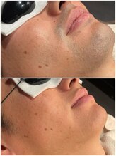 グロー(GLOW)/メンズヒゲ脱毛