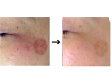 ドクターエイジレス(DR.AGELESS)/リアボーテフェイシャル/半年