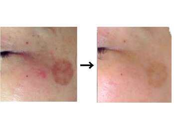 ドクターエイジレス(DR.AGELESS)/リアボーテフェイシャル/半年