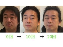 ラプリ 福岡天神店(Raplit)/メンズも歓迎☆美鼻＆小顔