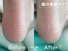 【2回目以降】《かかとの角質》ケア(ガサガサ踵にお悩みの方に) [フットケア]