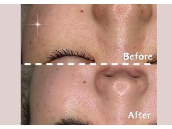 シー センター北(sii)/毛穴洗浄×ララピール