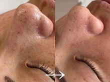 シェリー(cherie)/毛穴黒ずみ、たるみ毛穴