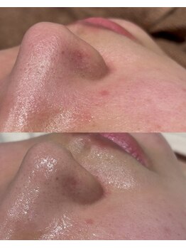 ラヴィン なんばスカイオ店(Lovin)/ハイドロ毛穴洗浄＆漢方ハーブ