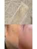〈山中限定◎〉ブラジリアンWax＋光脱毛　¥7,700