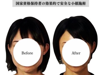 アロエベル(aloe Belle)/Before After（8回施術）