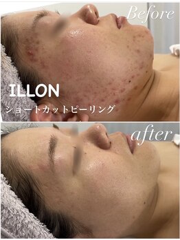 ボヌール バイ ユニ(bonHeuR by uni.)/ILLONショートカットピーリング