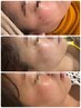 【全員OK】徹底美肌★シミ30個ケアし放題(1個2mm) ¥11,000