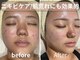 プルメリアの写真/肌質改善REVIハーブピーリングで毛穴・ニキビ・シミケア！繰り返す肌悩みを根本から◎
