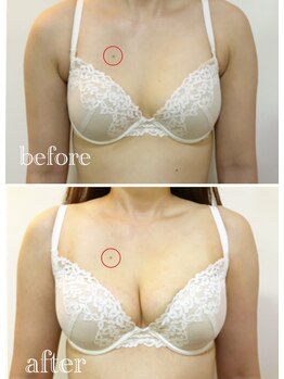 リール 新宿店(RIRE)/30代後半 バストアップ症例