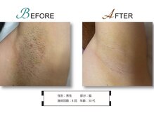 ココロ(KoKoRo)/VICTORIA 脱毛8回