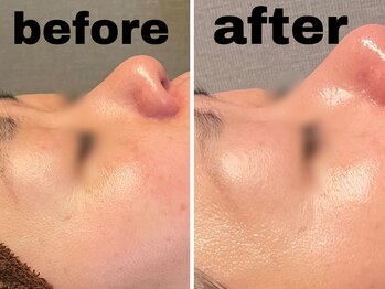 ブルーム(BLOOM)/REVI陶肌トリートメント