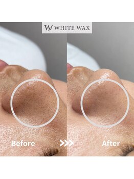 ホワイトワックス 浜松(WHITE WAX)/鼻の黒ずみこれで解消！