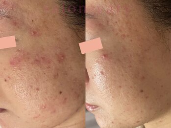 サロンヴェアリー 広尾(salon vary)/アトが得意なテクスパ