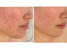 トゥモロー(TOMORROW)/ハーブピーリング/肌質改善