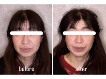 ウル 名駅(ulu)/美容鍼のビフォーアフターです♪