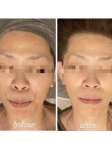 ラルミエール 緑店はなれ(la lumiere)/レモンボトル×コラーゲン糸