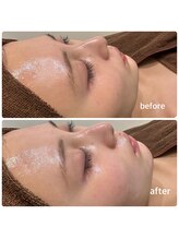 ミヌ 心斎橋(Minou)/ハーブピーリングbefore/after