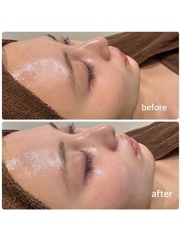 ミヌ 心斎橋(Minou)/ハーブピーリングbefore/after