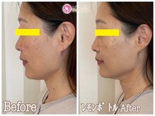 クリニカルエステ イーズ あべのキューズタウン店/40～50代　小顔むくみ