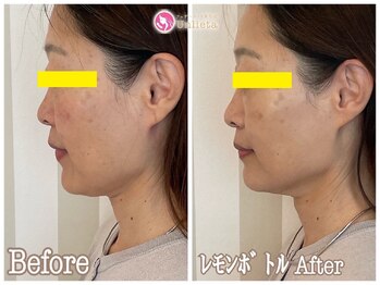 クリニカルエステ イーズ あべのキューズタウン店/40~50代 小顔むくみ