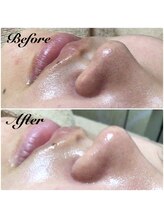 アフロディーテ(Aphrodite)/鼻ビフォーアフター！