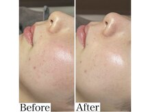 ワイグレイス(Y.GRACE)/マーメイドセルフェイシャル