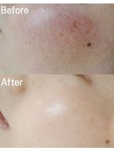 ロイヤル(ROYAL)/スキンメイド