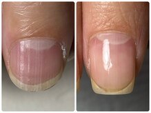 爪本来の美しさを取り戻し【健康な美爪】へ