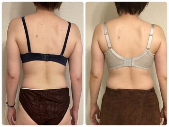 プリマ(prima)/バストアップ施術症例