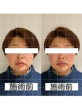 ヴィーライン 大阪梅田院(VeLine)/鍼灸／美容鍼／小顔／大阪／梅田