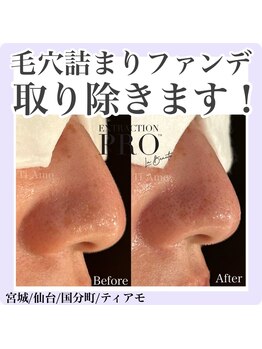 ティアモ(Ti Amo)/毛穴に詰まったファンデーション