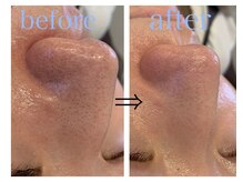 リジュベ(Rejuve)/毛穴洗浄/毛穴エステ/船橋/美肌